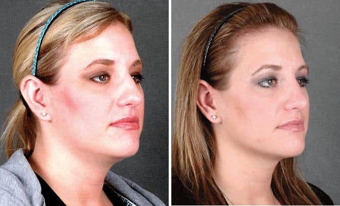 Rhinoplasty Before and After Photos in Omaha, NE, Case 5925