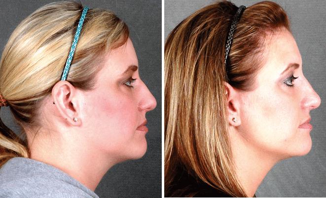 Rhinoplasty Before and After Photos in Omaha, NE, Case 5925