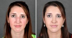 Rhinoplasty Before and After Photos in Omaha, NE, Case 5944