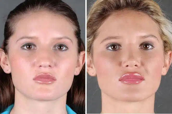 Rhinoplasty Before and After Photos in Omaha, NE, Case 5871