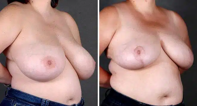 Breast Reduction Before and After Photos in Omaha, NE, Case 5973