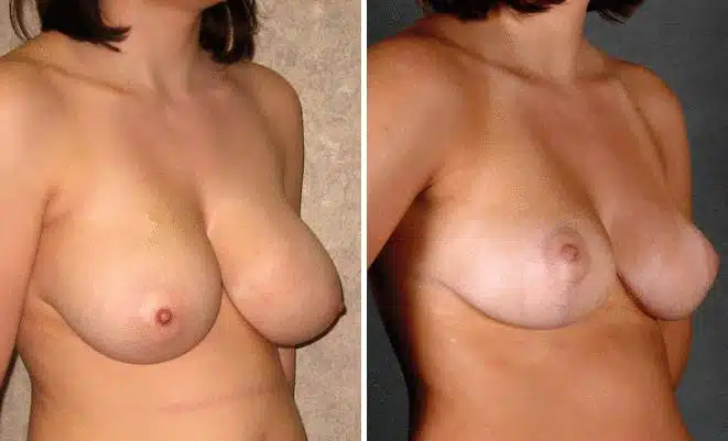 Breast Reduction Before and After Photos in Omaha, NE, Case 5980