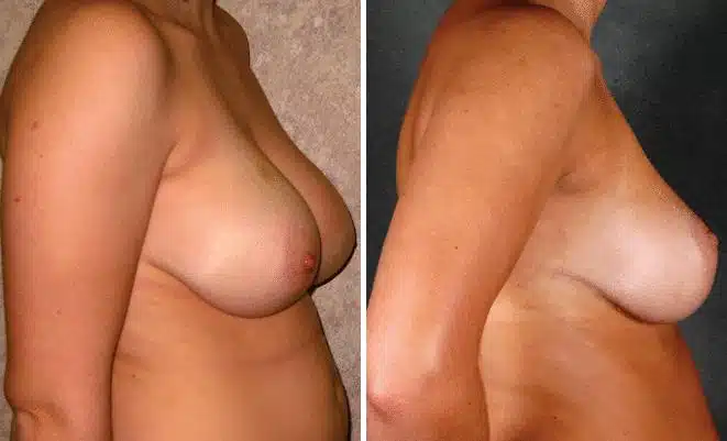 Breast Reduction Before and After Photos in Omaha, NE, Case 5980