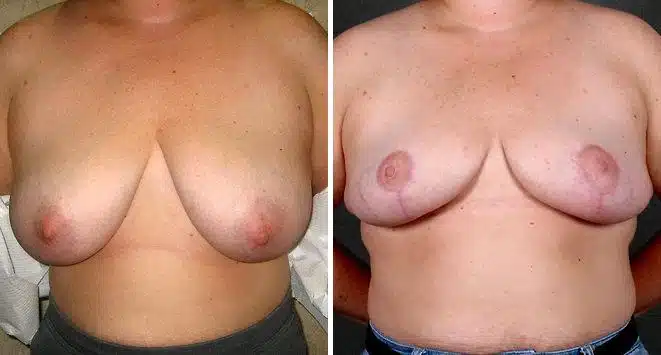 Breast Reduction Before and After Photos in Omaha, NE, Case 5987