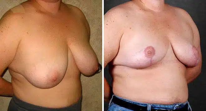 Breast Reduction Before and After Photos in Omaha, NE, Case 5987