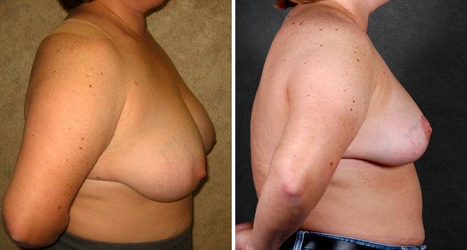 Breast Reduction Before and After Photos in Omaha, NE, Case 5987