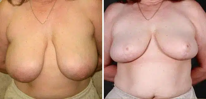 Breast Reduction Before and After Photos in Omaha, NE, Case 6000