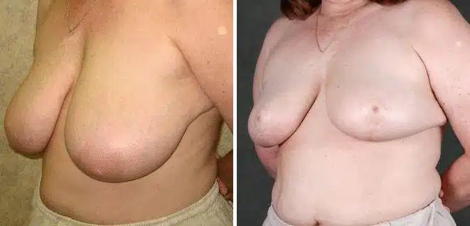 Breast Reduction Before and After Photos in Omaha, NE, Case 6000