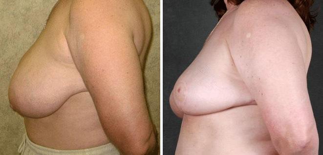 Breast Reduction Before and After Photos in Omaha, NE, Case 6000