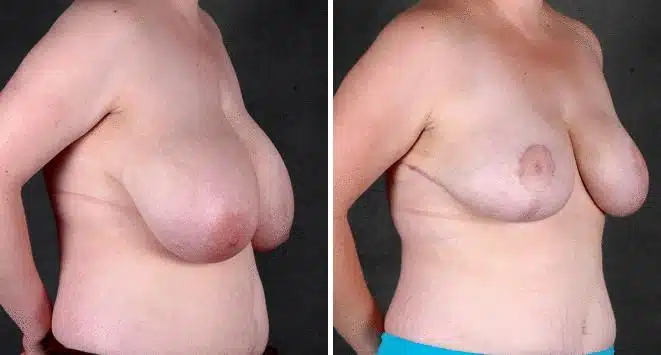 Breast Reduction Before and After Photos in Omaha, NE, Case 6007