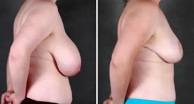 Breast Reduction Before and After Photos in Omaha, NE, Case 6007