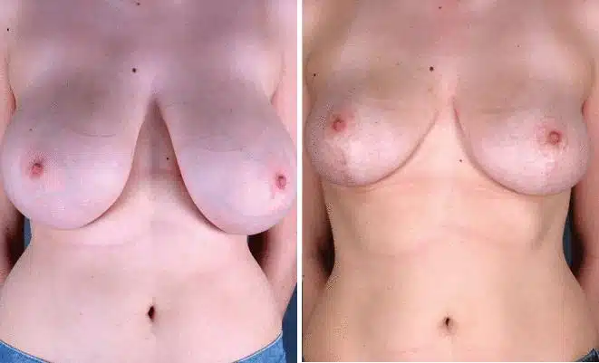 Breast Reduction Before and After Photos in Omaha, NE, Case 6014