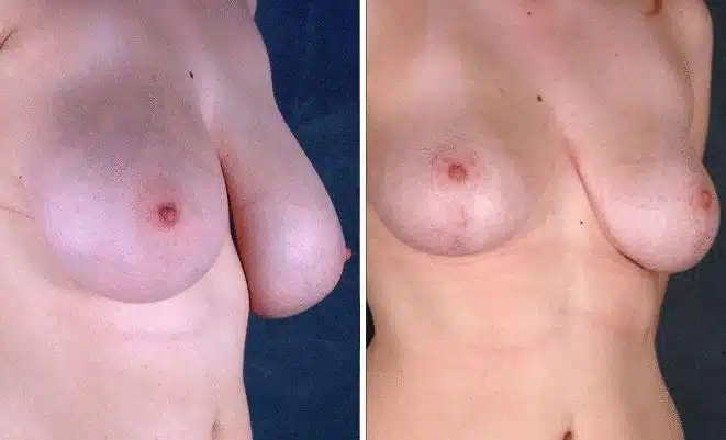 Breast Reduction Before and After Photos in Omaha, NE, Case 6014