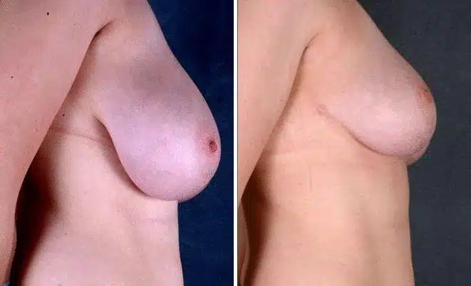 Breast Reduction Before and After Photos in Omaha, NE, Case 6014