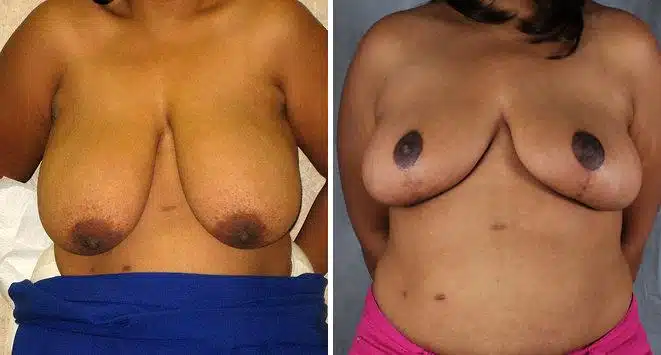 Breast Reduction Before and After Photos in Omaha, NE, Case 6040