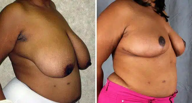 Breast Reduction Before and After Photos in Omaha, NE, Case 6040