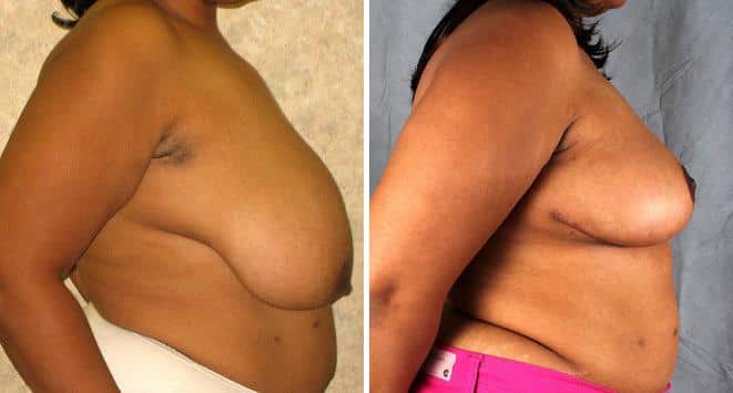 Breast Reduction Before and After Photos in Omaha, NE, Case 6040