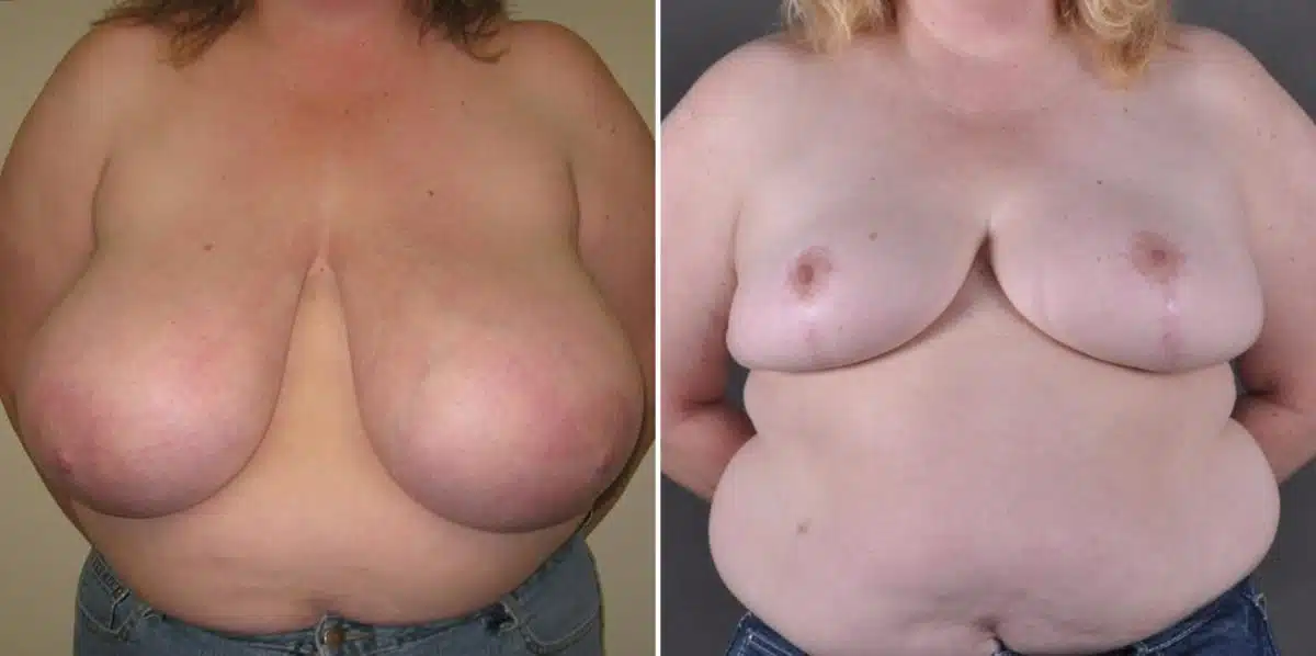 Breast Reduction Before and After Photos in Omaha, NE, Case 7795