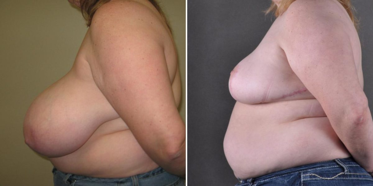 Breast Reduction Before and After Photos in Omaha, NE, Case 7795