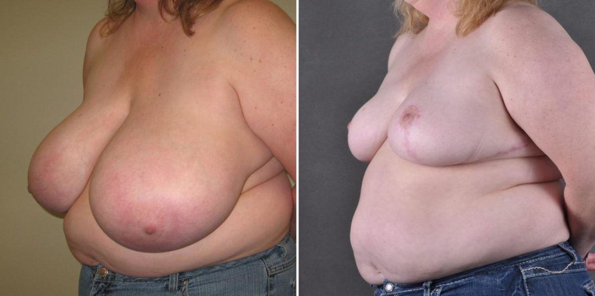 Breast Reduction Before and After Photos in Omaha, NE, Case 7795