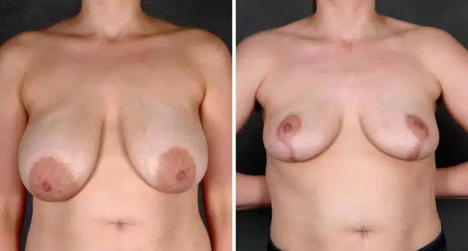 Breast Reduction Before and After Photos in Omaha, NE, Case 5966