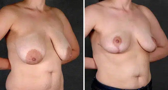 Breast Reduction Before and After Photos in Omaha, NE, Case 5966