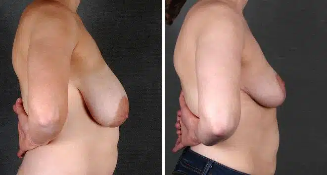 Breast Reduction Before and After Photos in Omaha, NE, Case 5966