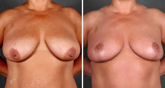 Breast Reduction Before and After Photos in Omaha, NE, Case 5922