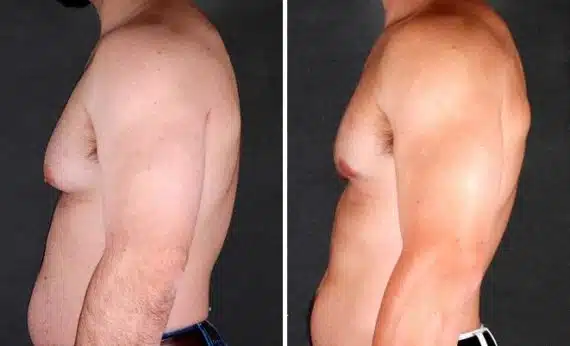 Gynecomastia Before and After Photos in Omaha, NE, Case 6048