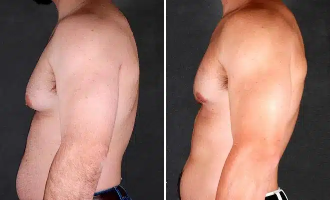 Gynecomastia Before and After Photos in Omaha, NE, Case 6048