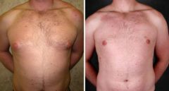 Gynecomastia Before and After Photos in Omaha, NE, Case 6060