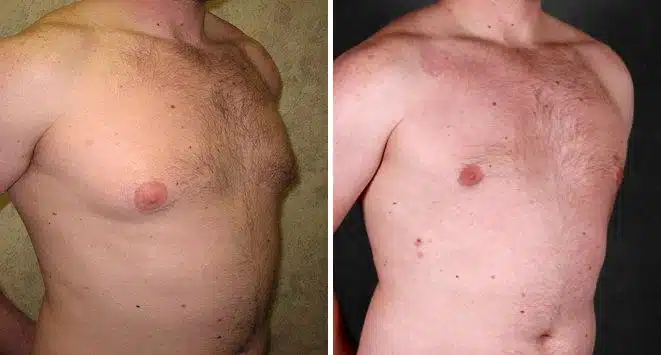 Gynecomastia Before and After Photos in Omaha, NE, Case 6060