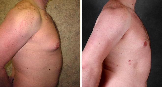 Gynecomastia Before and After Photos in Omaha, NE, Case 6060