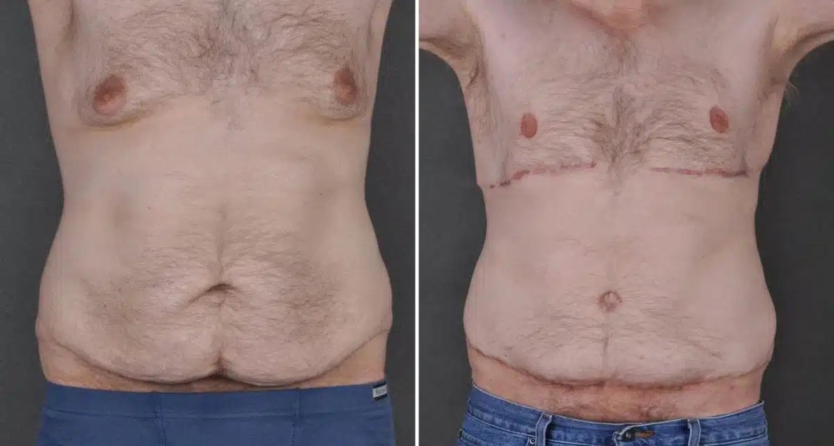 Gynecomastia Before and After Photos in Omaha, NE, Case 8866