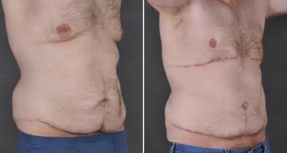 Gynecomastia Before and After Photos in Omaha, NE, Case 8866