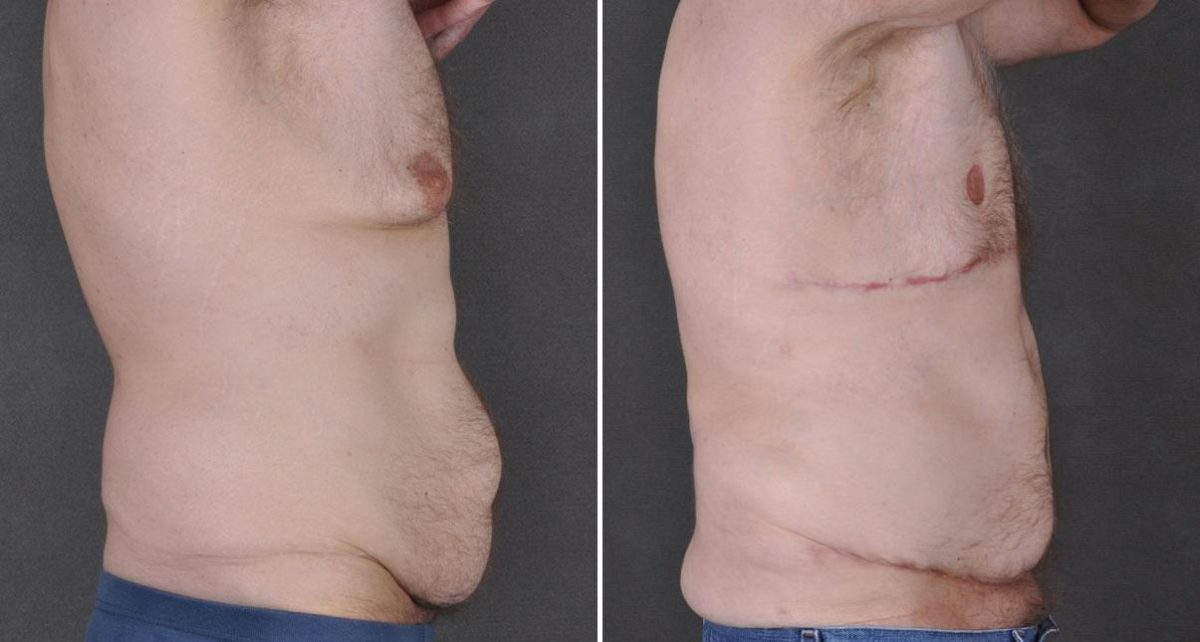 Gynecomastia Before and After Photos in Omaha, NE, Case 8866