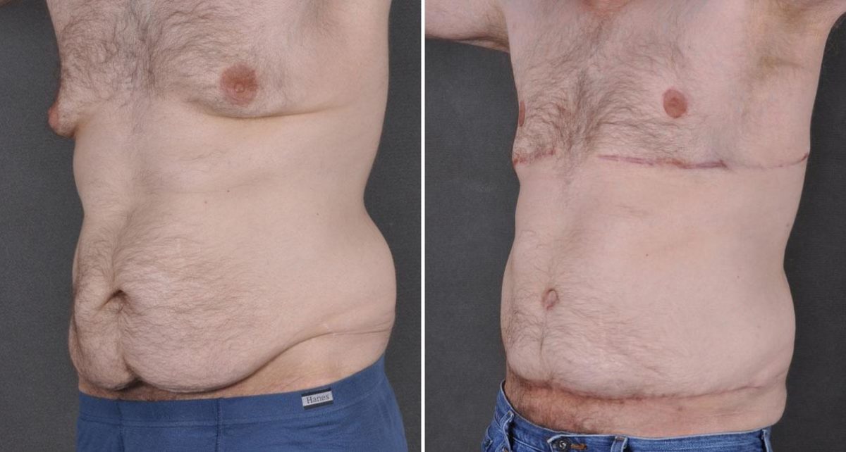 Gynecomastia Before and After Photos in Omaha, NE, Case 8866