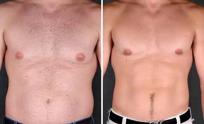 Gynecomastia Before and After Photos in Omaha, NE, Case 6048