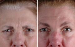 Botox Cosmetic Before and After Photos in Omaha, NE, Case 6067