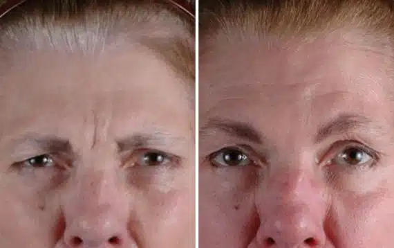 Botox Cosmetic Before and After Photos in Omaha, NE, Case 6067