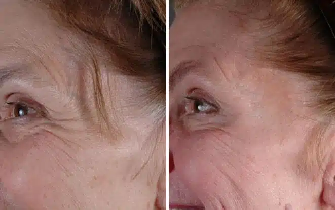 Botox Results Day by Day: How Quickly Does Botox Show Effects?, Before and After Photos Botox Cosmetic Before and After Photos in Omaha, NE, Case 6067