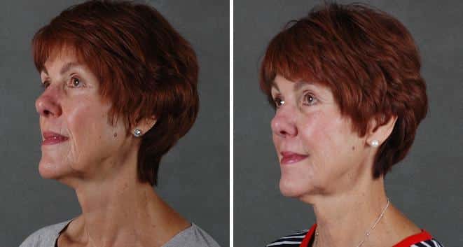Case 6072, Juvéderm Before and After Photos Juvéderm Before and After Photos in Omaha, NE, Case 6072