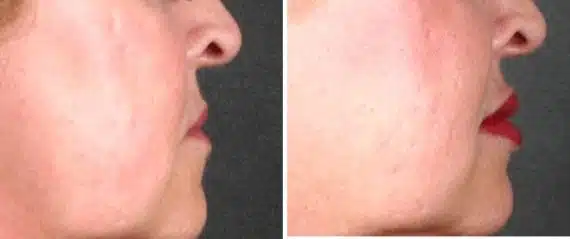 Juvéderm Before and After Photos in Omaha, NE, Case 6079