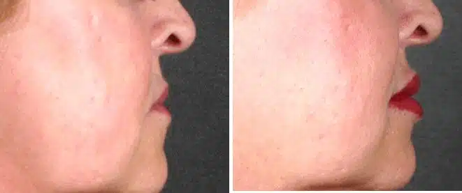 Juvéderm Before and After Photos in Omaha, NE, Case 6079