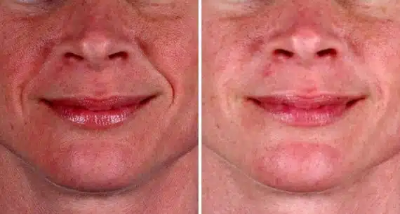 Juvéderm Before and After Photos in Omaha, NE, Case 6087