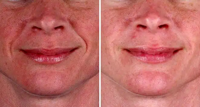 Juvéderm Before and After Photos in Omaha, NE, Case 6087