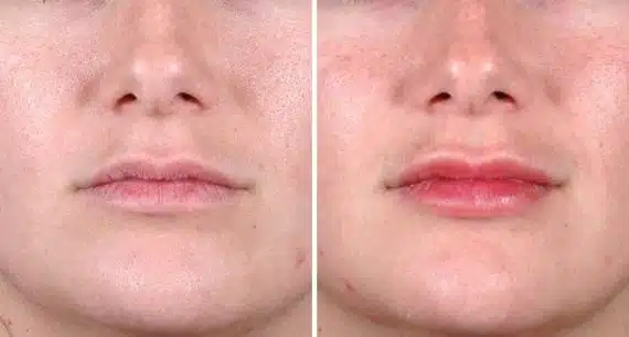 Juvéderm Before and After Photos in Omaha, NE, Case 6090