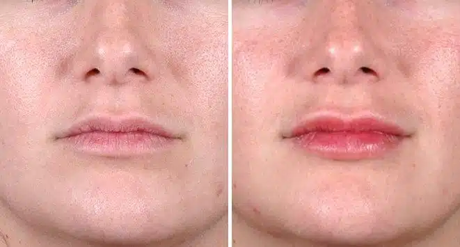 Juvéderm Before and After Photos in Omaha, NE, Case 6090