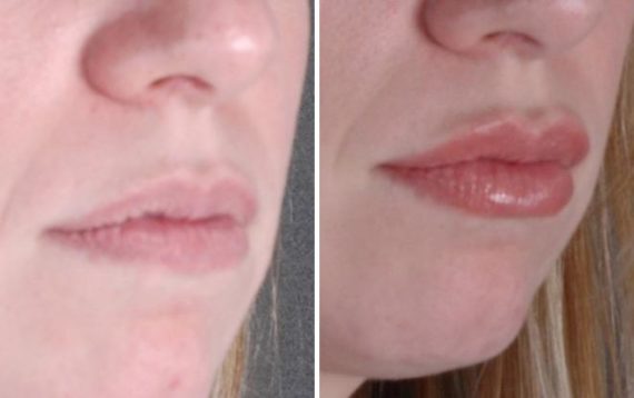 Juvéderm Before and After Photos in Omaha, NE, Case 6093