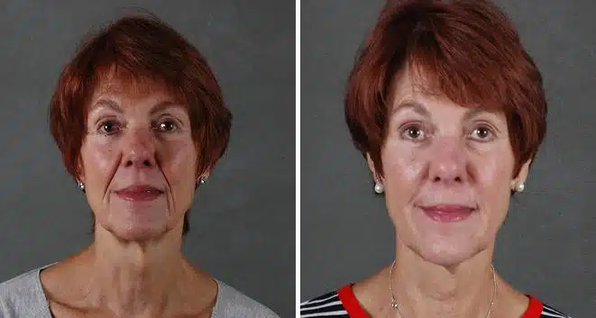 Case 6072, Juvéderm Before and After Photos Juvéderm Before and After Photos in Omaha, NE, Case 6072